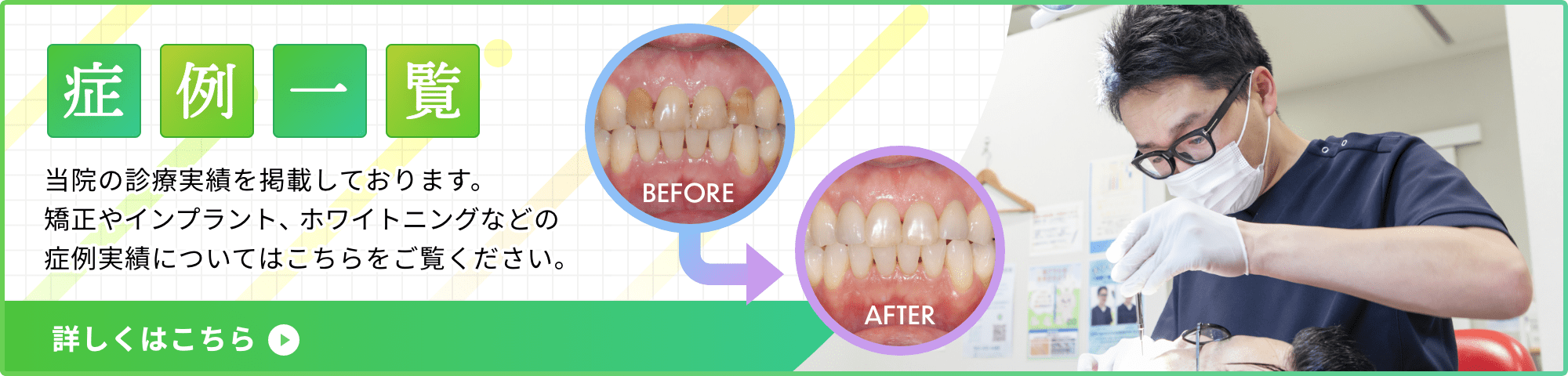 症例一覧 当院の診療実績を掲載しております。矯正やインプラント、ホワイトニングなどの症例実績についてはこちらをご覧ください。